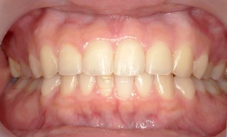 部分矯正 前歯「八の字/V字型」症例写真