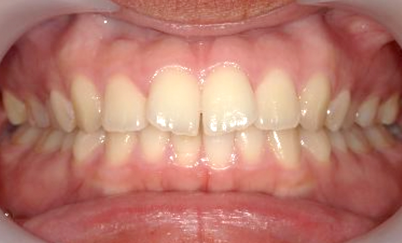 部分矯正 前歯「八の字/V字型」症例写真