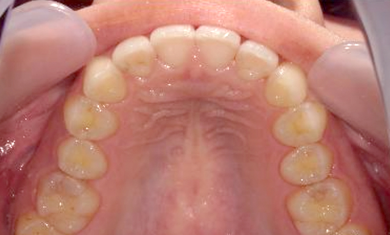 部分矯正 前歯「八の字/V字型」症例写真