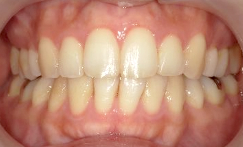 部分矯正 前歯「八の字/V字型」症例写真