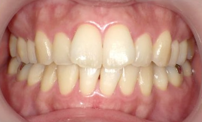 部分矯正 前歯「八の字/V字型」症例写真