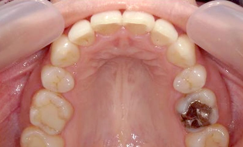 部分矯正 前歯「八の字/V字型」症例写真