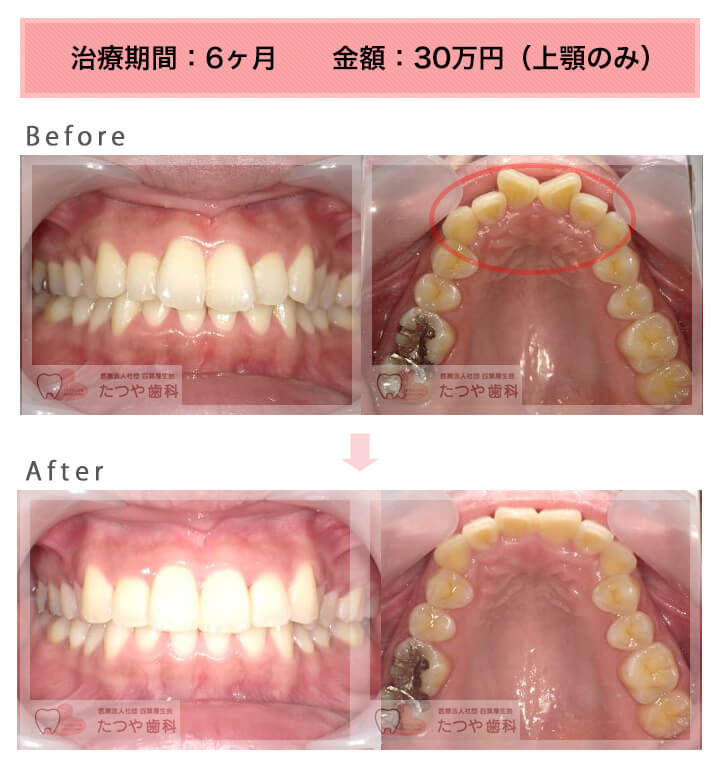 部分矯正の症例　前歯「八の字/V字型」