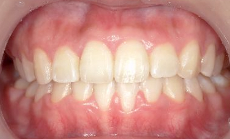 部分矯正 前歯「八の字/V字型」症例写真