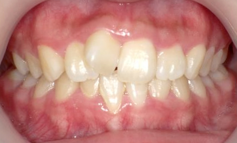 部分矯正 前歯「八の字/V字型」症例写真