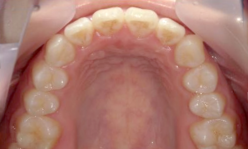 部分矯正 前歯「八の字/V字型」症例写真