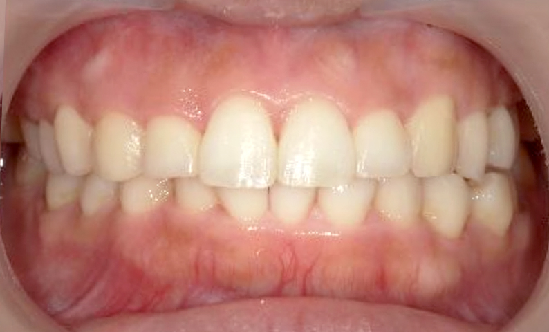 部分矯正 前歯「八の字/V字型」症例写真