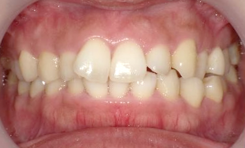 部分矯正 前歯「八の字/V字型」症例写真