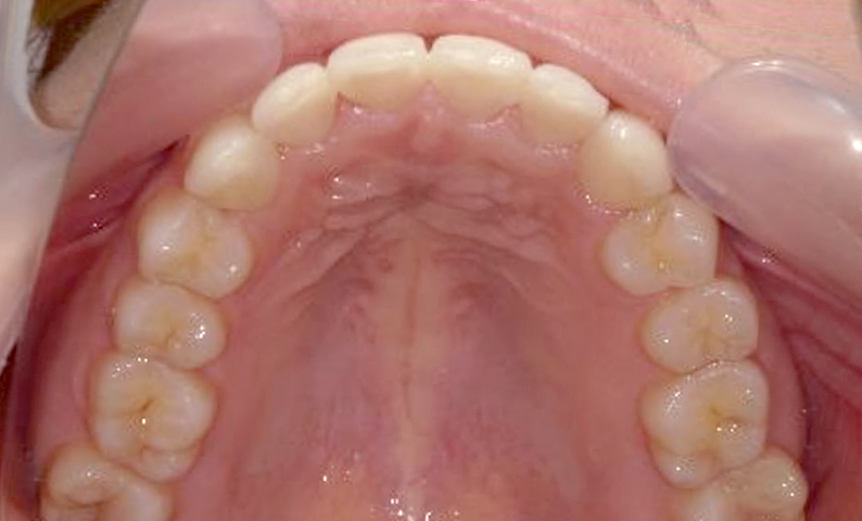 部分矯正 前歯「八の字/V字型」症例写真