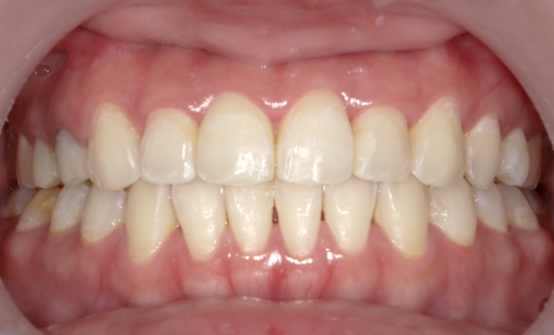 部分矯正 前歯「八の字/V字型」症例写真