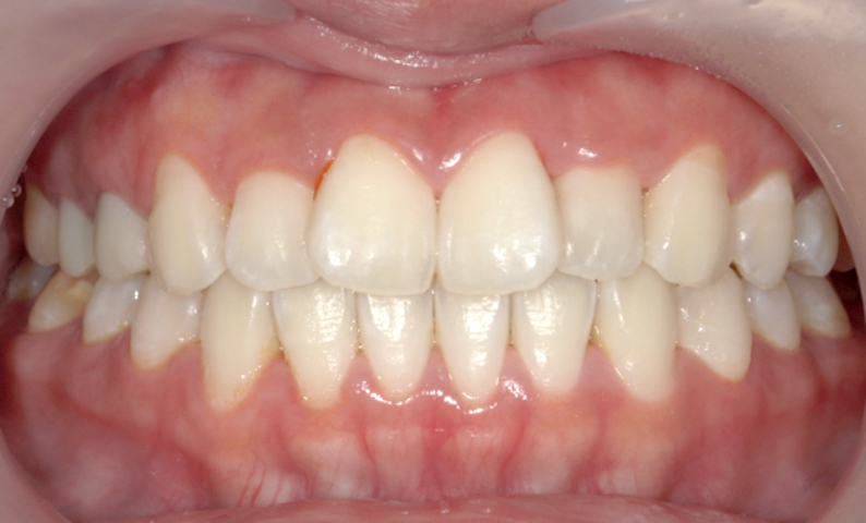 部分矯正 前歯「八の字/V字型」症例写真