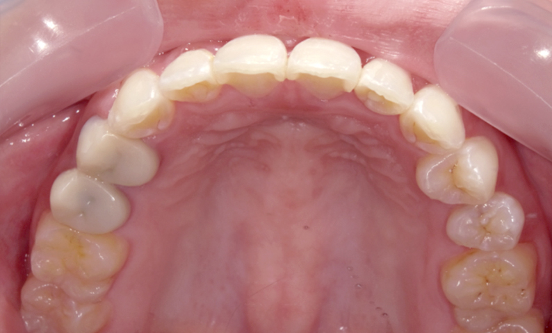 部分矯正 前歯「八の字/V字型」症例写真