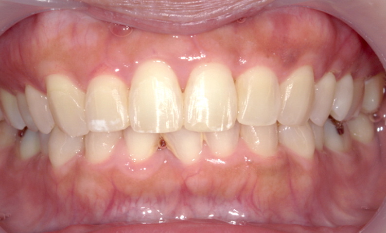 部分矯正 前歯「八の字/V字型」症例写真