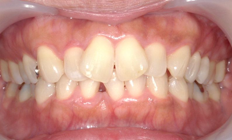 部分矯正 前歯「八の字/V字型」症例写真