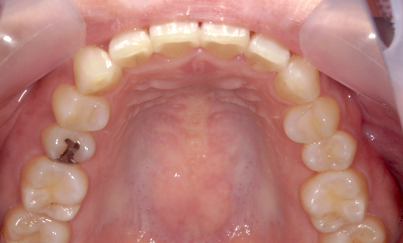 部分矯正 前歯「八の字/V字型」症例写真