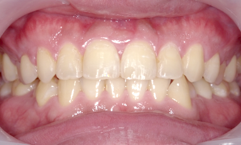 部分矯正 前歯「八の字/V字型」症例写真