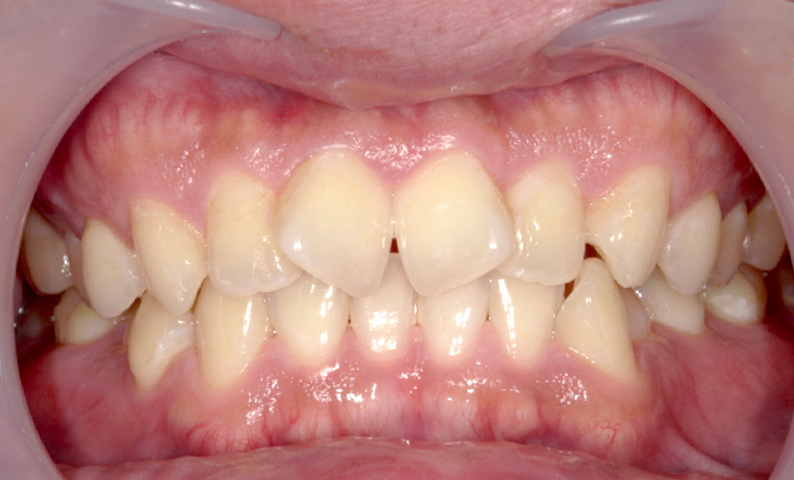 部分矯正 前歯「八の字/V字型」症例写真