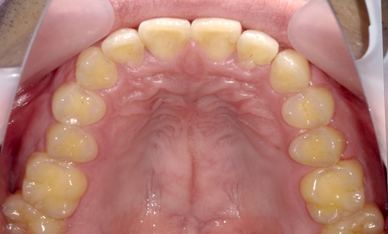 部分矯正 前歯「八の字/V字型」症例写真