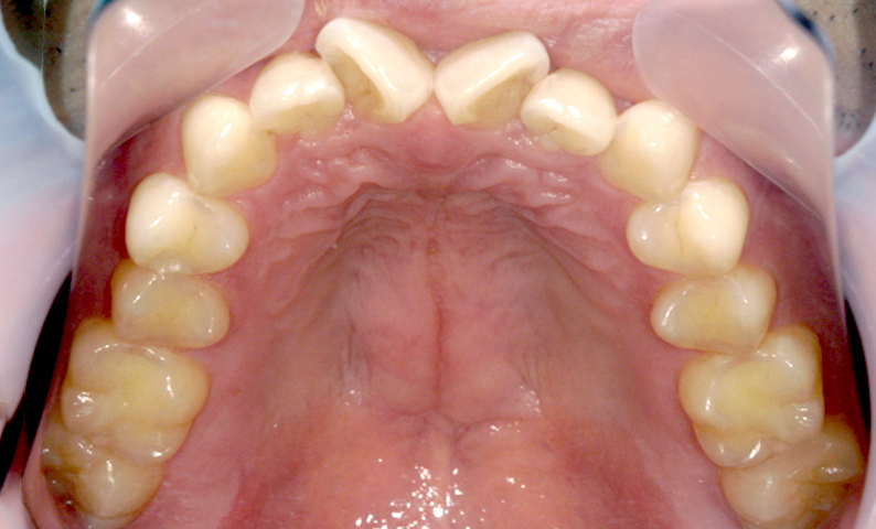 部分矯正 前歯「八の字/V字型」症例写真