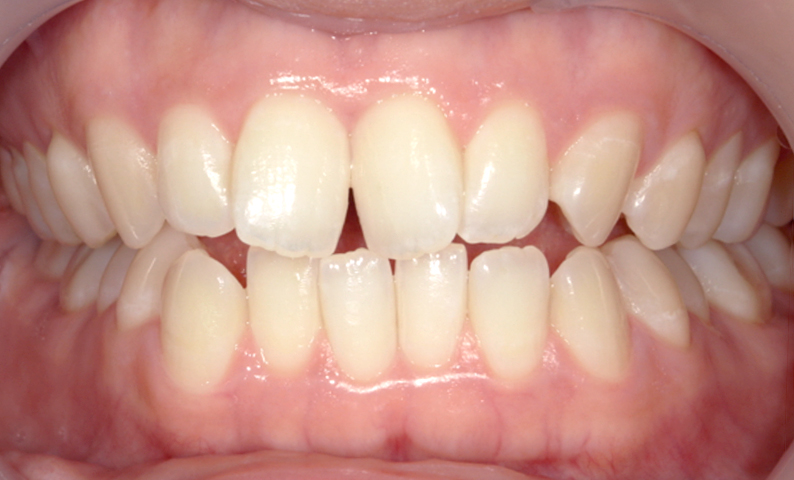 部分矯正 前歯「八の字/V字型」症例写真