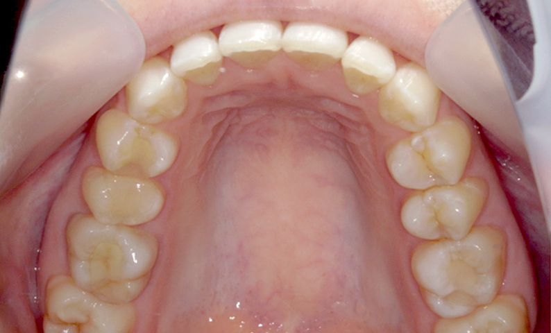 部分矯正 前歯「八の字/V字型」症例写真