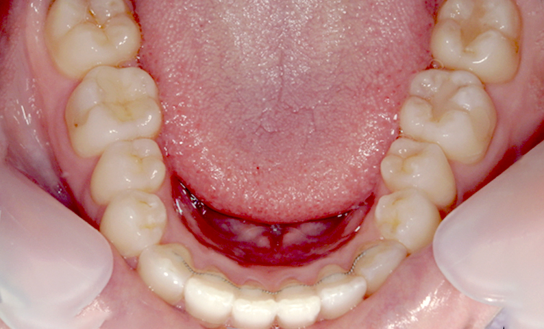 部分矯正 前歯「八の字/V字型」症例写真