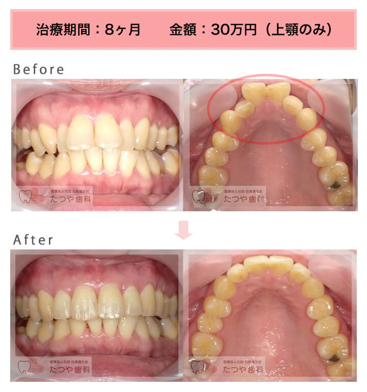 部分矯正の症例　前歯「八の字/V字型」