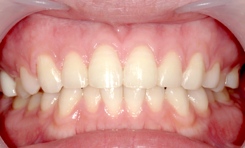 部分矯正 前歯「八の字/V字型」症例写真