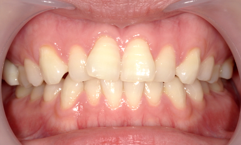 部分矯正 前歯「八の字/V字型」症例写真