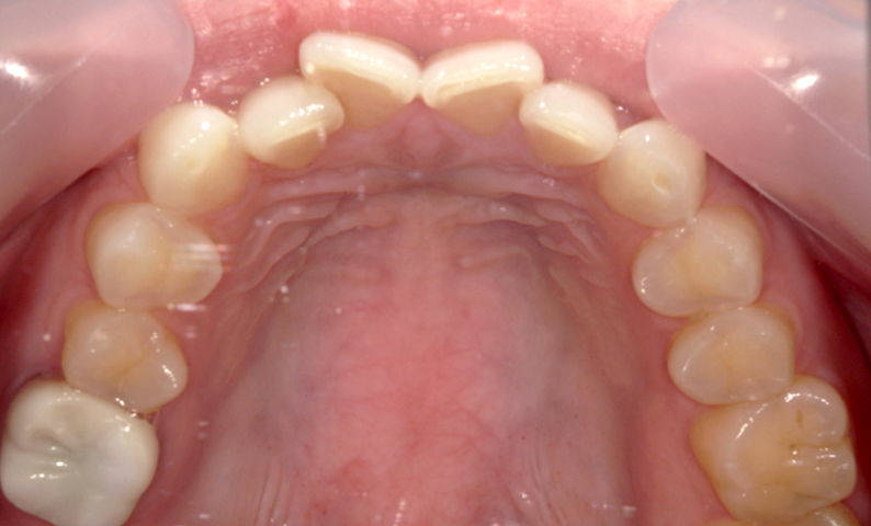 部分矯正 前歯「八の字/V字型」症例写真