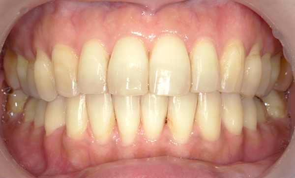 部分矯正 前歯「八の字/V字型」症例写真