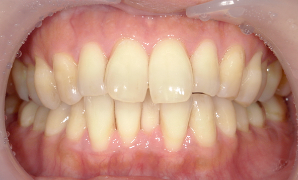 部分矯正 前歯「八の字/V字型」症例写真