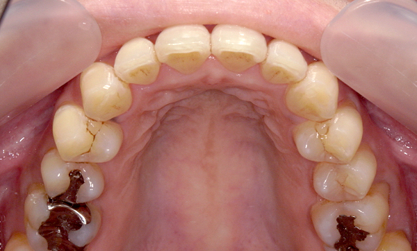 部分矯正 前歯「八の字/V字型」症例写真