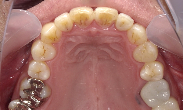 部分矯正 前歯「八の字/V字型」症例写真