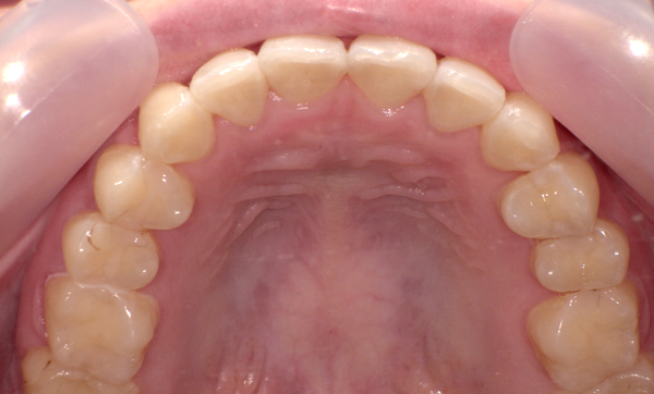 部分矯正 前歯「八の字/V字型」症例写真