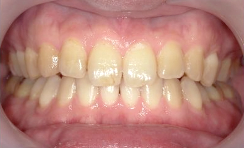 部分矯正 下の部分矯正の症例写真