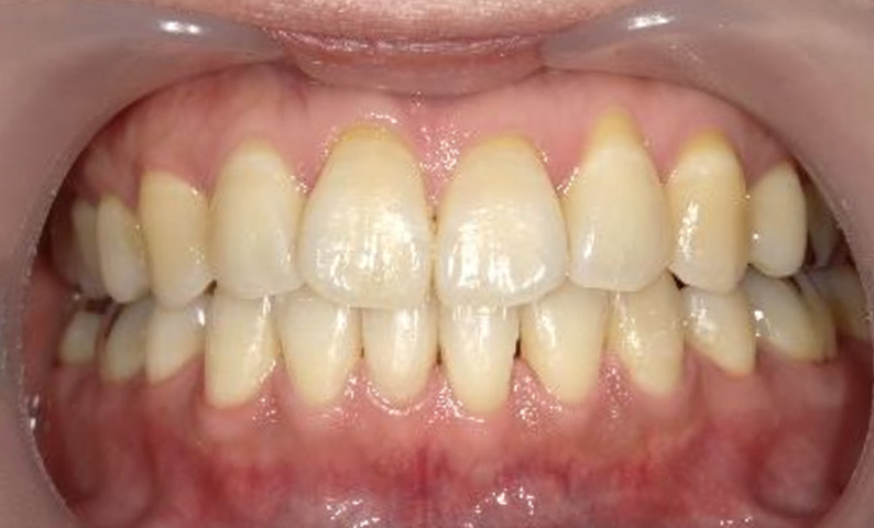 部分矯正 下の部分矯正の症例写真