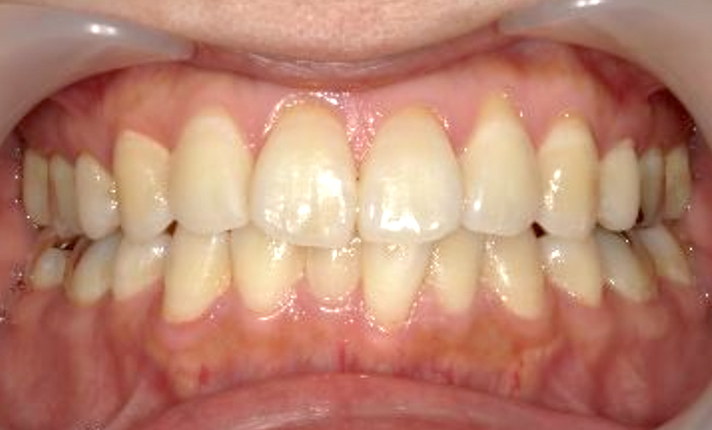 部分矯正 下の部分矯正の症例写真