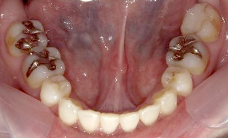 部分矯正 下の部分矯正の症例写真