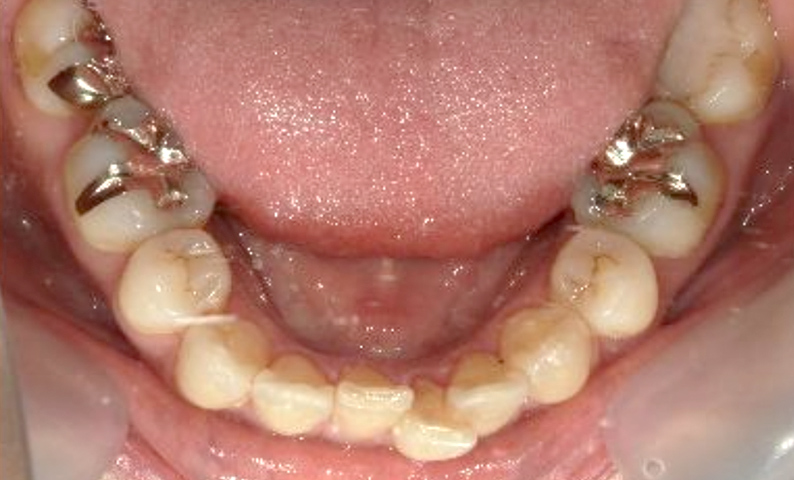 部分矯正 下の部分矯正の症例写真