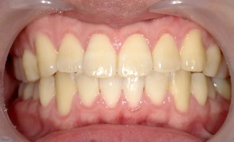 部分矯正 下の部分矯正の症例写真