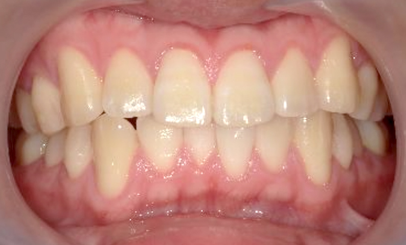 部分矯正 下の部分矯正の症例写真