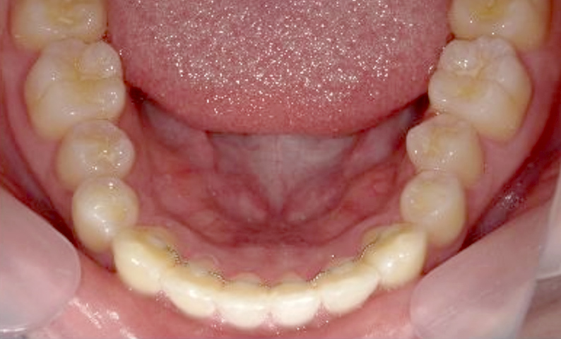 部分矯正 下の部分矯正の症例写真