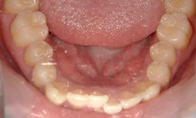 部分矯正 下の部分矯正の症例写真