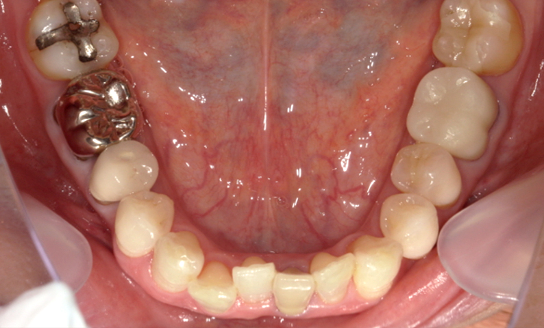 部分矯正 下の部分矯正の症例写真