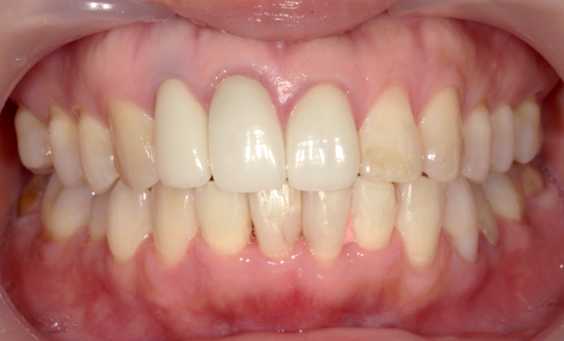 部分矯正 下の部分矯正の症例写真