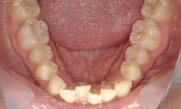 部分矯正 下の部分矯正の症例写真