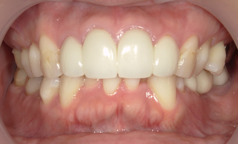 部分矯正 下の部分矯正の症例写真