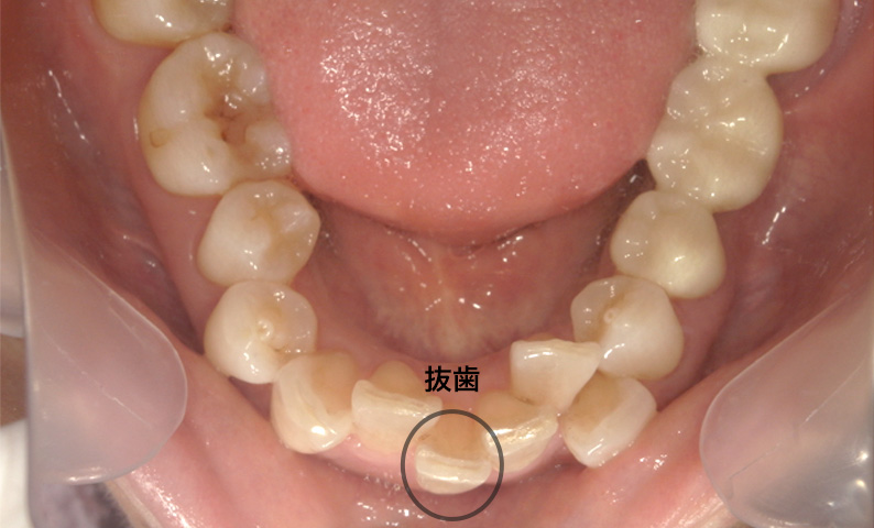 部分矯正 下の部分矯正の症例写真