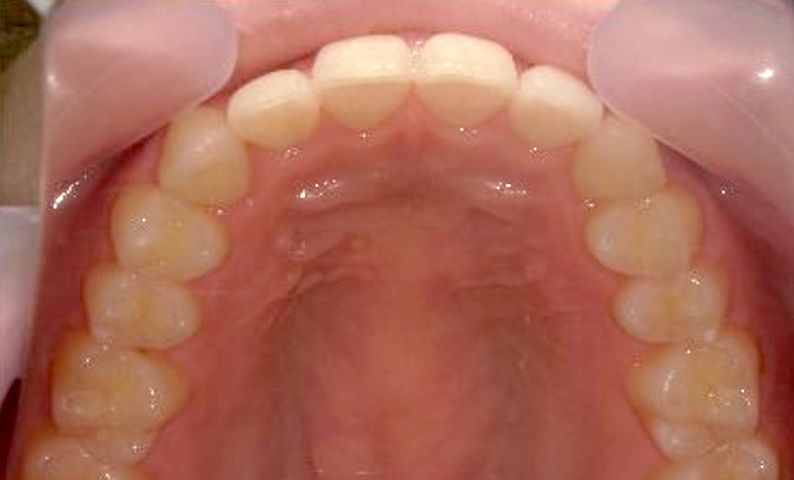 部分矯正すきっ歯の症例写真